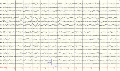 Surgical Outcomes and EEG Prognostic Factors After Stereotactic Laser Amygdalohippocampectomy for Mesial Temporal Lobe Epilepsy